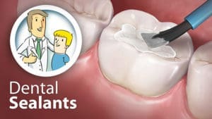 Illustration of tooth sealant application with dentist and child inset, emphasizing dental sealant services in East Lansing clinics.