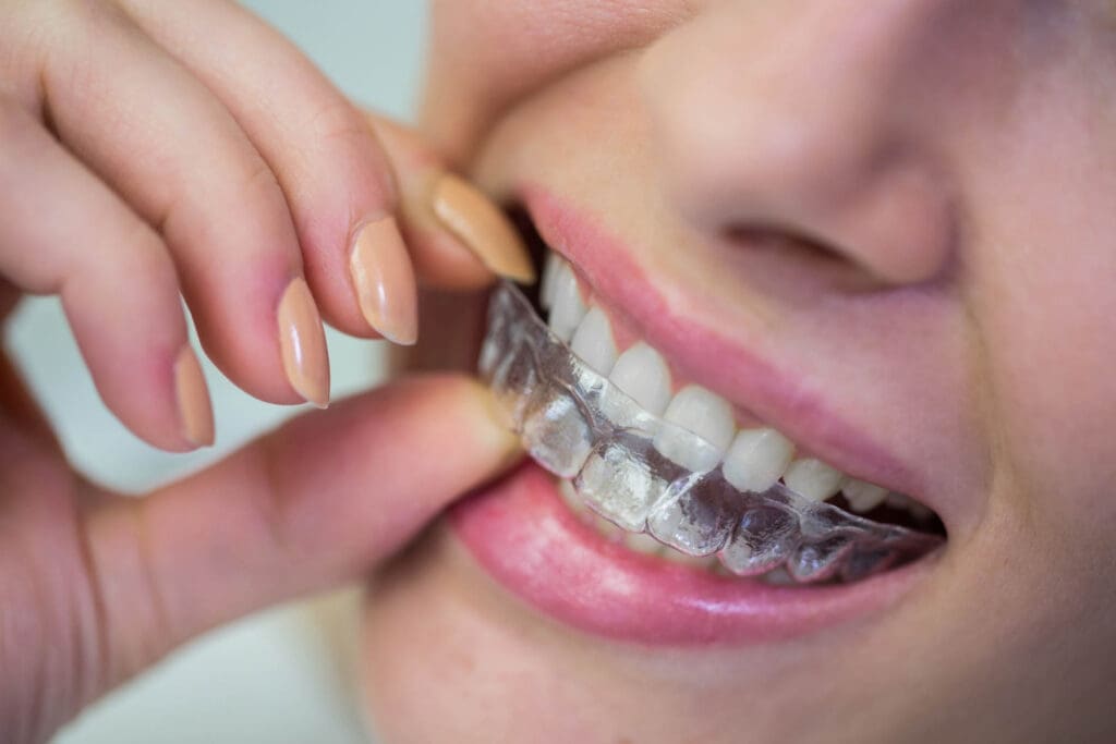 Invisalign Clear Aligners in East Lansing
