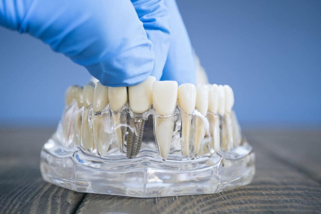 Gloved hand holding clear dental model with metal implant, on wooden surface, blue background—illustrates implant services in East Lansing.